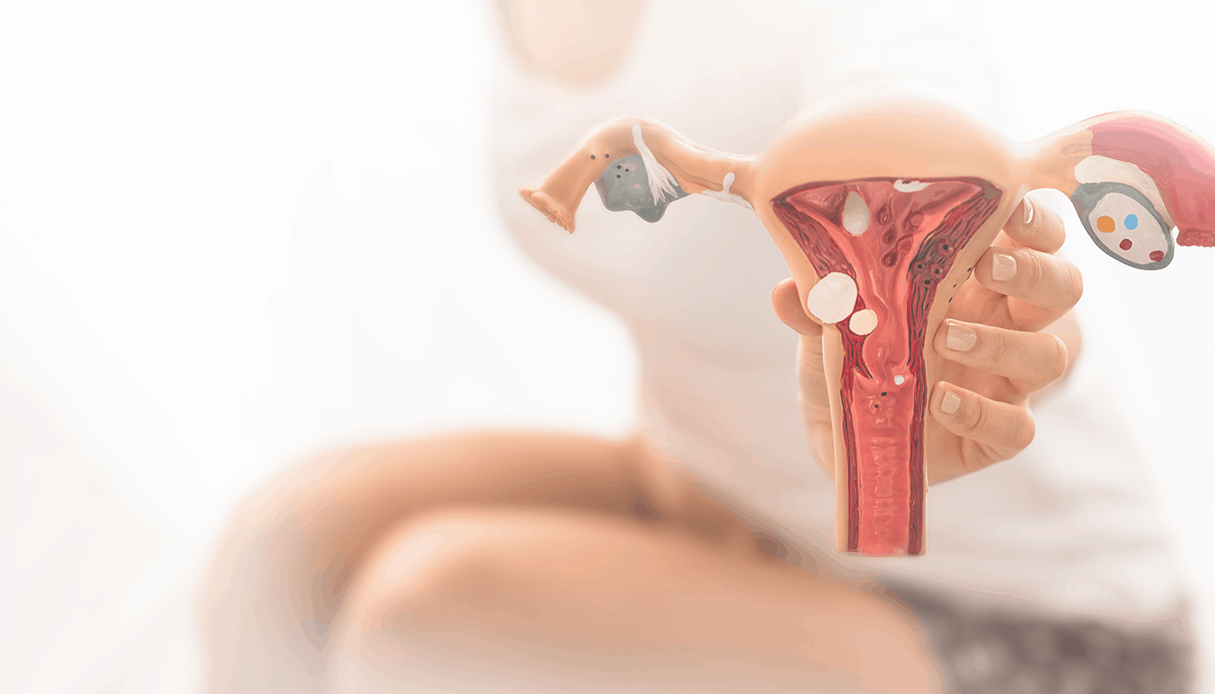 Você está visualizando atualmente Saúde da mulher – Endometriose